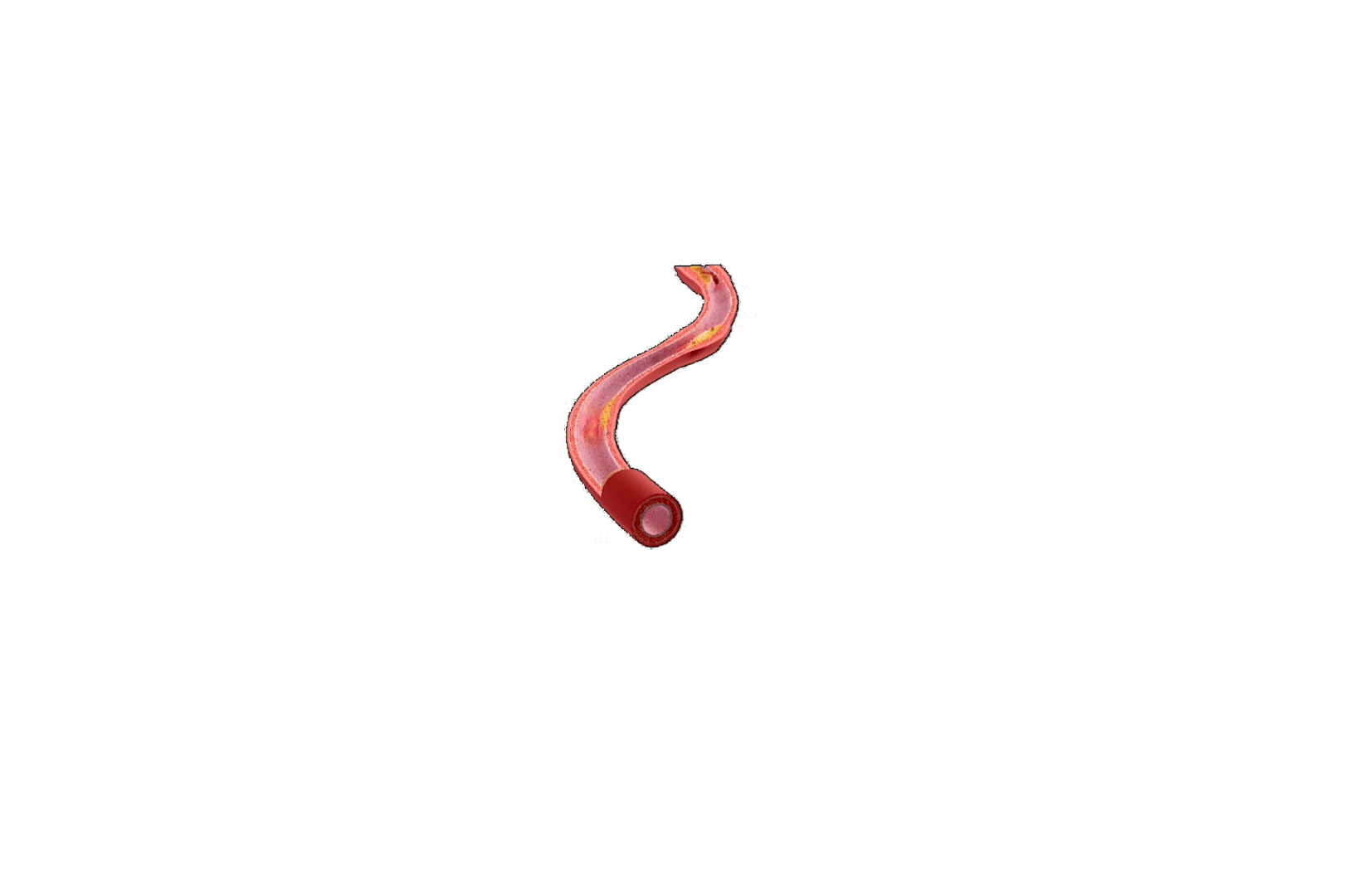 Atherosclerosis sequence