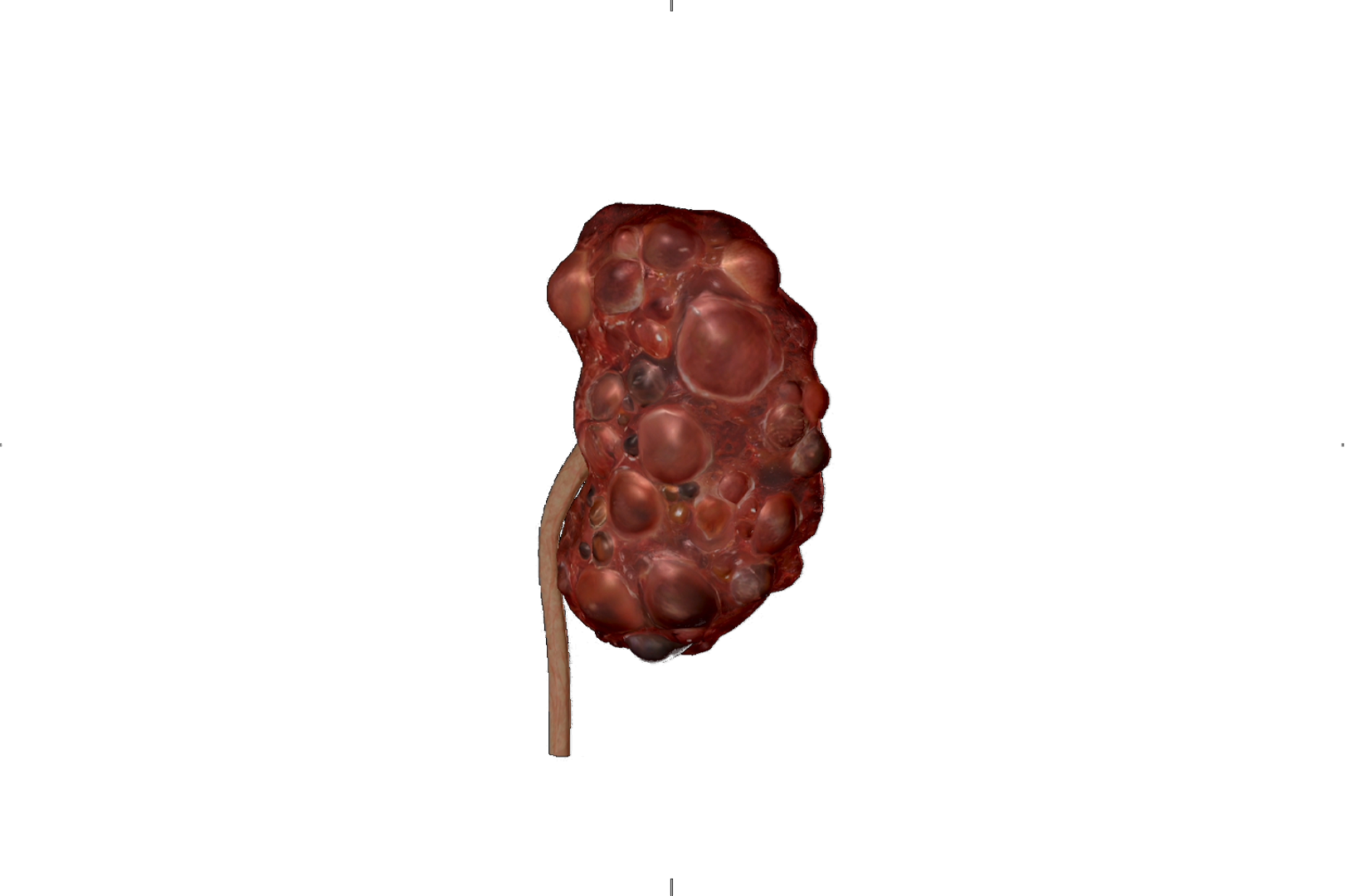 Chronic kidney disease sequence